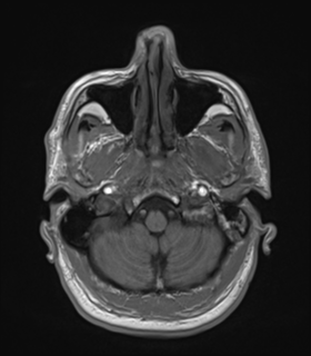 Anaplastic astrocytoma IDH wild-type (Radiopaedia 49984-55273 Axial T1 10).png