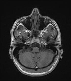 Anaplastic astrocytoma IDH wild-type (Radiopaedia 49984-55273 Axial T1 13).png