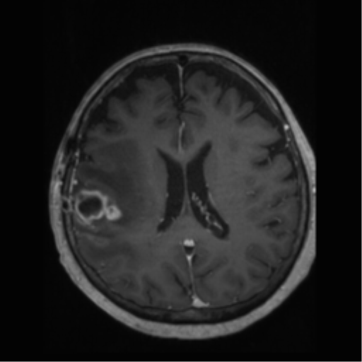 File:Anaplastic astrocytoma IDH wild-type (pseudoprogression) (Radiopaedia 42209-45277 Axial T1 C+ 76).png