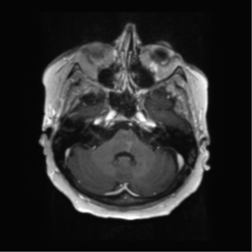 File:Anaplastic astrocytoma IDH wild-type (pseudoprogression) (Radiopaedia 42209-45279 Axial T1 C+ 37).png