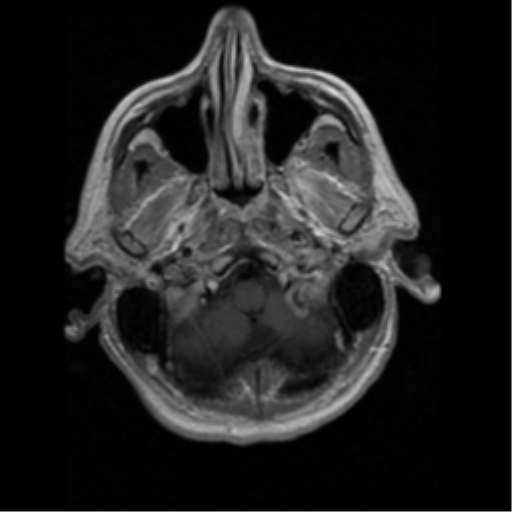 File:Anaplastic meningioma with recurrence (Radiopaedia 34452-35783 Axial T1 C+ 1).png