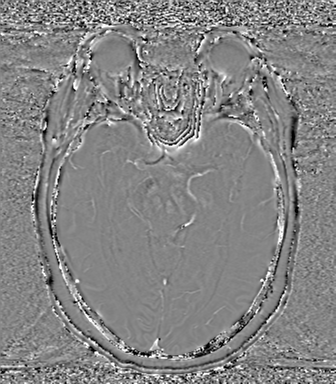 Anaplastic oligodendroglioma (Radiopaedia 83500-98599 Axial SWI - phase 35).png