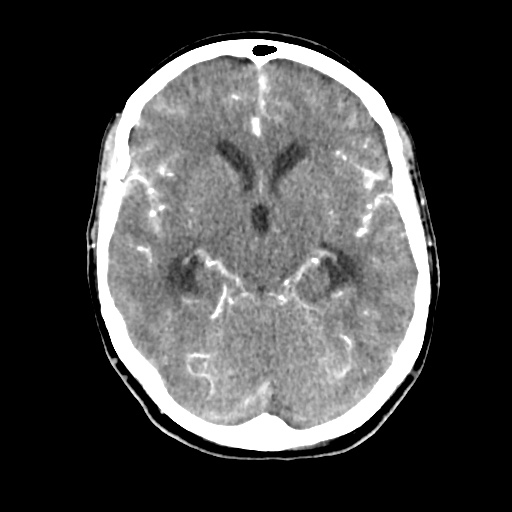 Aneursym related subarachnoid hemorrhage with hydrocephalus (Radiopaedia 45105-49084 D 22).jpg