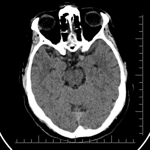 File:Aneurysm of posterior communicating artery (Radiopaedia 20188-20162 Axial non-contrast 17).jpg