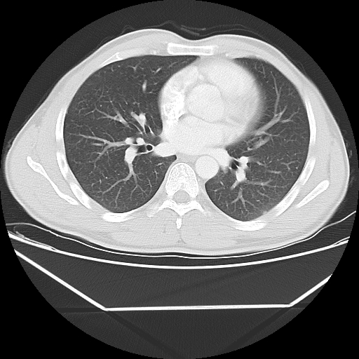 Aneurysmal bone cyst - rib (Radiopaedia 82167-96220 Axial lung window 38).jpg