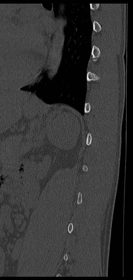Aneurysmal bone cyst T11 (Radiopaedia 29294-29721 Sagittal bone window 17).jpg