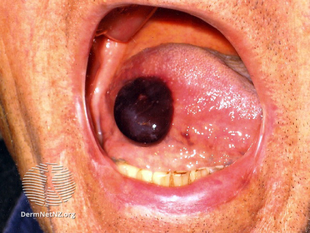 File:Angina bullosa haemorrhagica (DermNet NZ site-age-specific-angina-bullosa).jpg