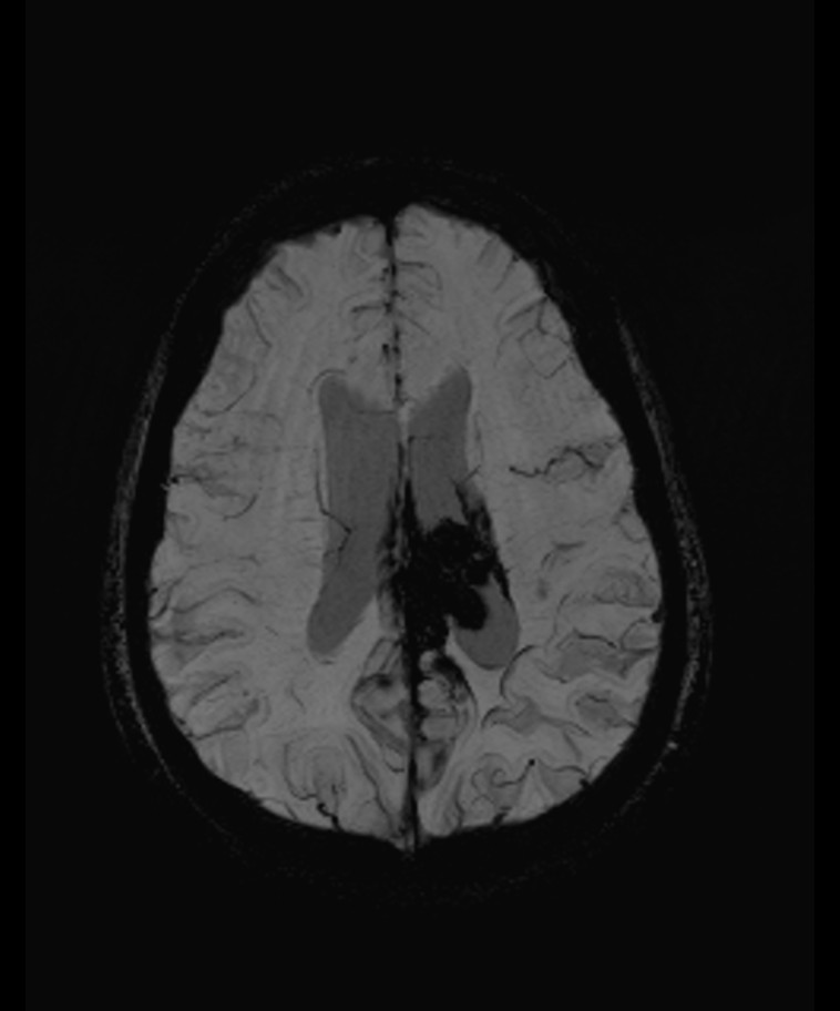 Angiomatous meningioma (Radiopaedia 79459-92579 E 44).jpg