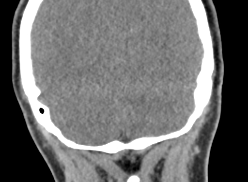 Angular dermoid cyst (Radiopaedia 88967-105790 Coronal non-contrast 105).jpg