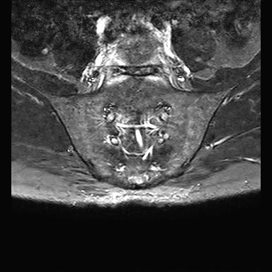 File:Ankylosing spondylitis with zygapophyseal arthritis (Radiopaedia 38433-40517 D 5).jpg