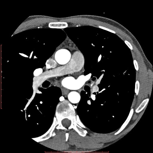 File:Anomalous left coronary artery from the pulmonary artery (ALCAPA) (Radiopaedia 70148-80181 A 23).jpg