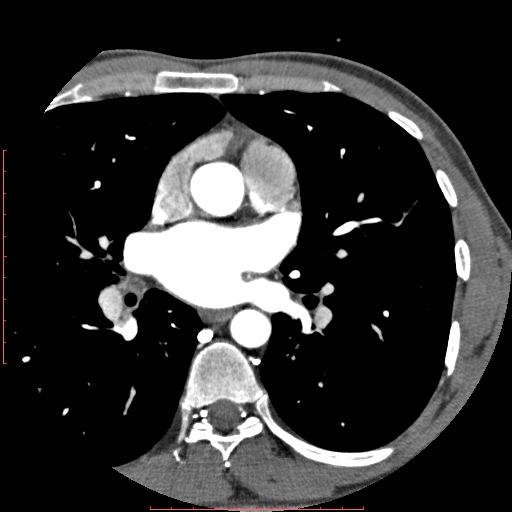 File:Anomalous left coronary artery from the pulmonary artery (ALCAPA) (Radiopaedia 70148-80181 A 77).jpg