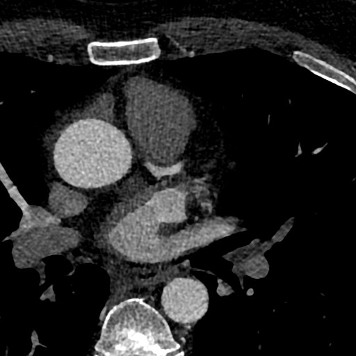 File:Anomalous origin of the left coronary artery with malignant course (Radiopaedia 77842-90126 C 13).jpeg