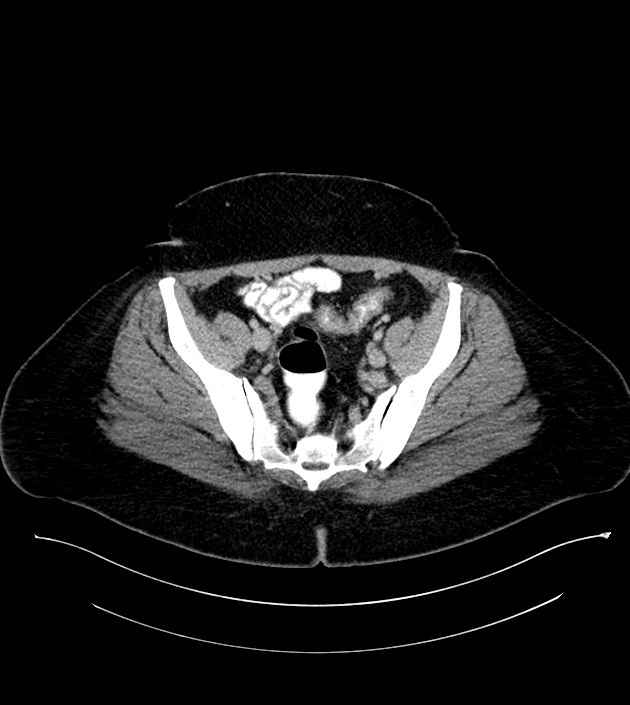 Anterior abdominal wall CSF pseudocyst (CSFoma) (Radiopaedia 79453-92571 A 74).jpg
