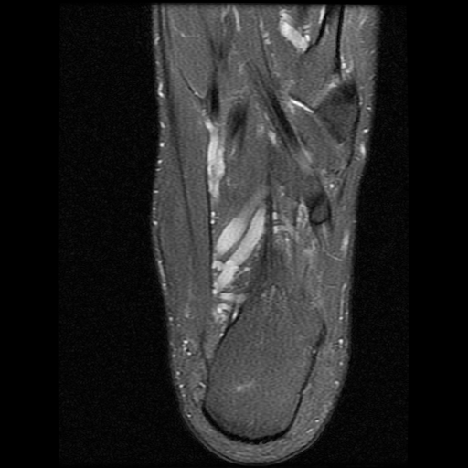 File:Anterior calcaneal process fracture (Radiopaedia 74654-85611 Axial PD fat sat 24).jpg