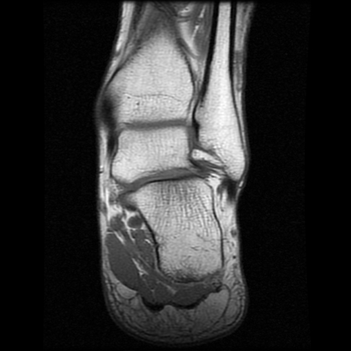File:Anterior calcaneal process fracture (Radiopaedia 74654-85611 Coronal T1 16).jpg