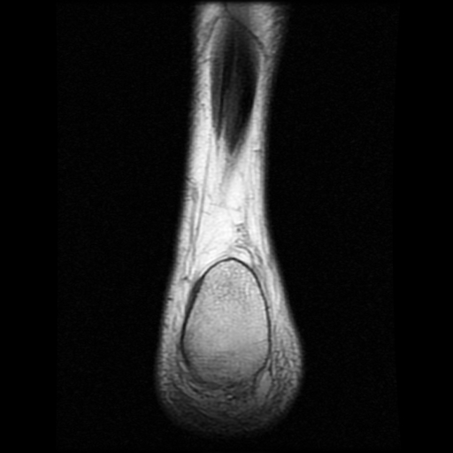 File:Anterior calcaneal process fracture (Radiopaedia 74654-85611 Coronal T1 26).jpg
