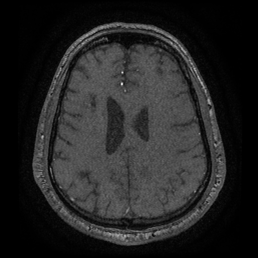 Anterior cerebral artery infarction (Radiopaedia 46794-51323 Axial MRA 158).jpg
