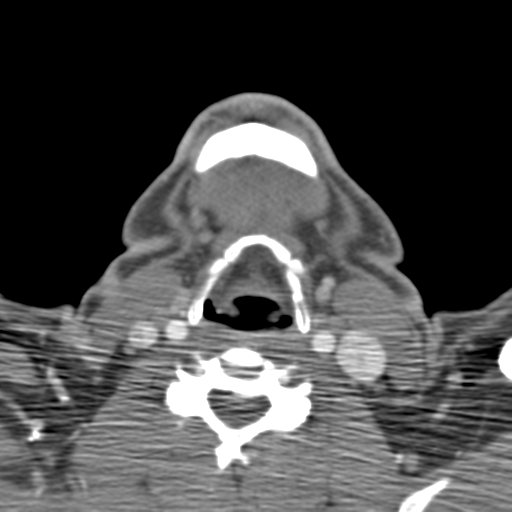 File:Anterior cerebral artery territory infarct (Radiopaedia 39327-41581 B 80).png