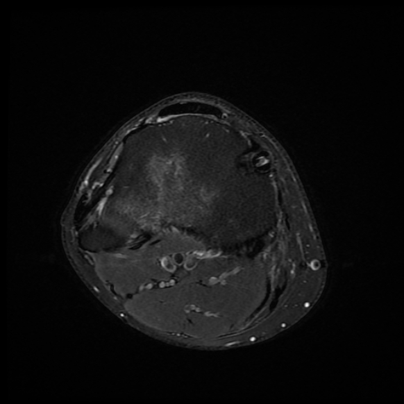 File:Anterior cruciate ligament graft tear and bucket-handle tear of medial meniscus (Radiopaedia 75867-87254 Axial PD fat sat 4).jpg