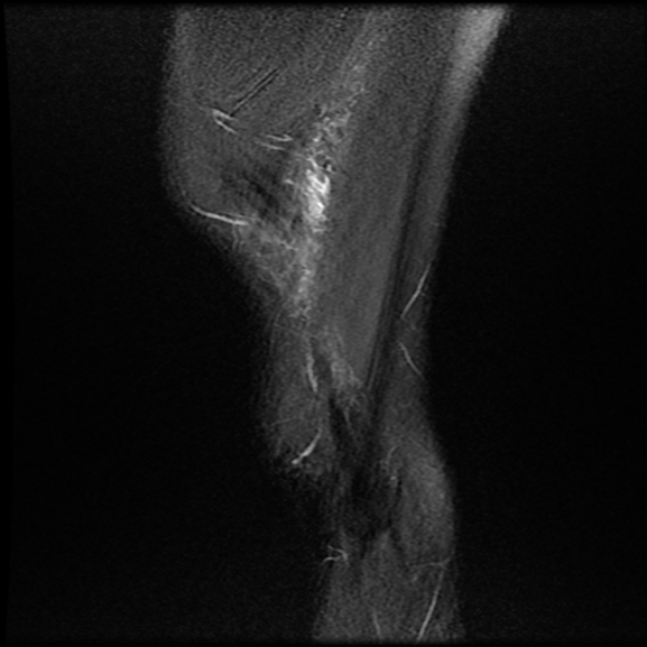 File:Anterior cruciate ligament graft tear and bucket-handle tear of medial meniscus (Radiopaedia 75867-87255 Sagittal PD fat sat 28).jpg