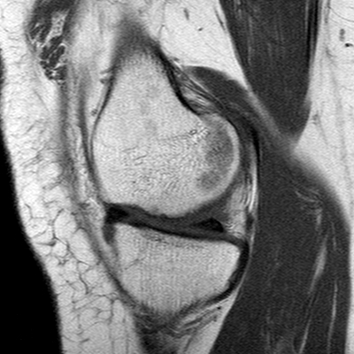 File:Anterior cruciate ligament mucoid degeneration (Radiopaedia 60853-68633 Sagittal T1 40).jpg