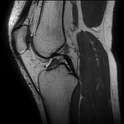 Anterior cruciate ligament rupture and posteromedial corner injury (Radiopaedia 67338-76723 Sagittal PD 83).jpg