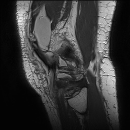 Anterior cruciate ligament rupture with Segond fracture (Radiopaedia 69043-78806 Sagittal PD 162).jpg