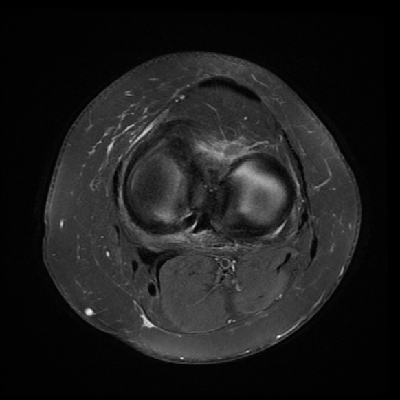 File:Anterior cruciate ligament tear, Wrisberg rip and bucket-handle tear of medial meniscus (Radiopaedia 75872-87266 Axial PD fat sat 10).jpg