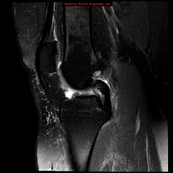 File:Anterior cruciate ligament tear (Radiopaedia 12329-12612 E 12).jpg
