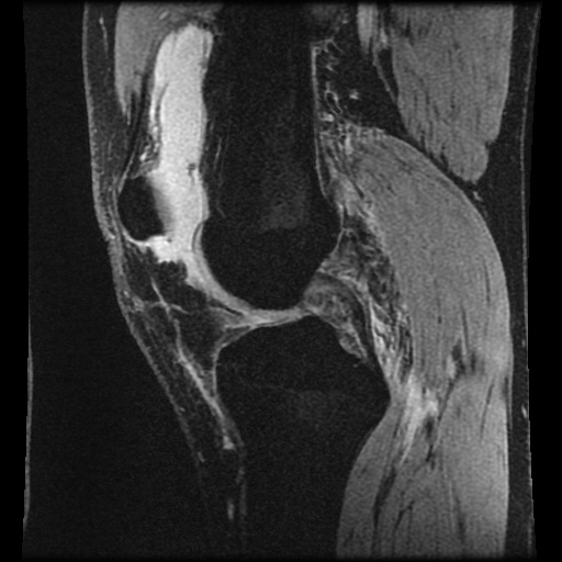Anterior cruciate ligament tear (Radiopaedia 61500-69462 F 36).jpg