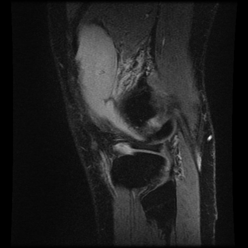 Anterior cruciate ligament tear (Radiopaedia 61500-69462 F 80).jpg