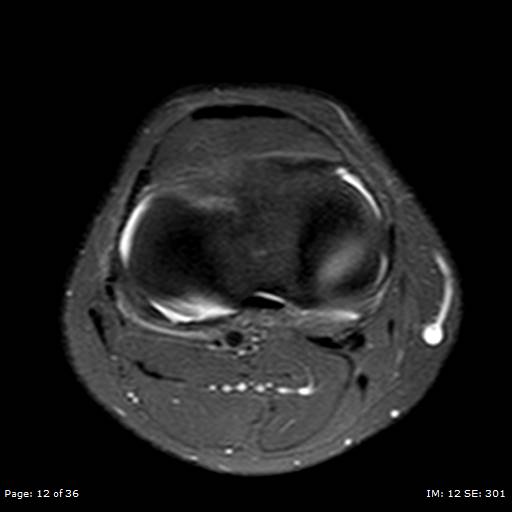 File:Anterior cruciate ligament tear (Radiopaedia 70783-80964 Axial PD fat sat 12).jpg