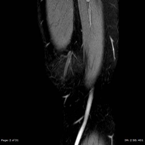 File:Anterior cruciate ligament tear (Radiopaedia 70783-80964 Sagittal STIR 2).jpg