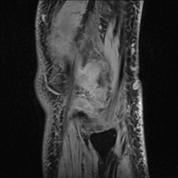 Anterior cruciate ligament tear - ramp lesion (Radiopaedia 71883-82322 Sagittal T1 vibe 18).jpg