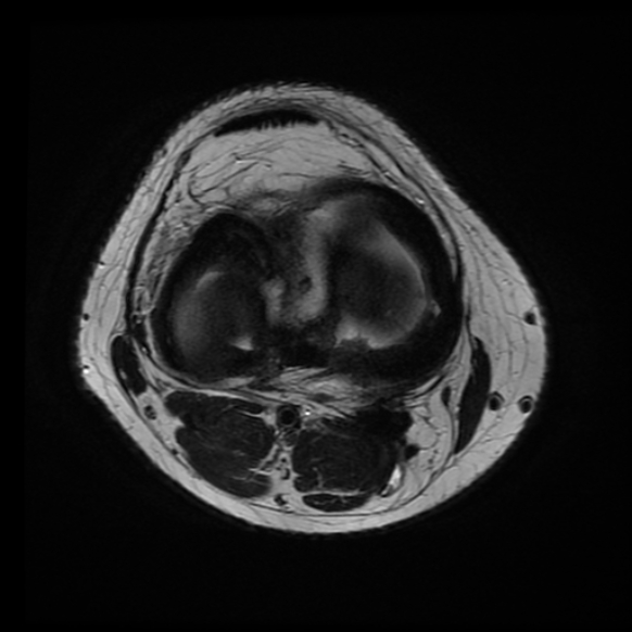 File:Anterior cruciate ligament tear with posteromedial corner injury, bucket-handle meniscal tear and chondral delamination (Radiopaedia 75501-86744 Axial T2 9).jpg