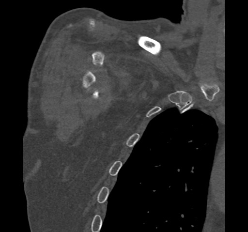 Anterior glenohumeral dislocation with Hill-Sachs lesion (Radiopaedia 62877-71249 Coronal bone window 10).jpg