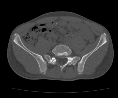 Anterior inferior iliac spine avulsion fracture (Radiopaedia 81312-94999 Axial bone window 23).jpg