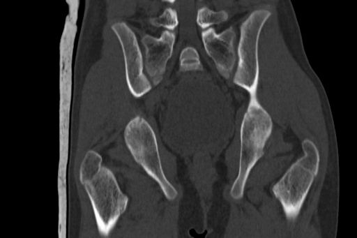 Anterior inferior iliac spine avulsion injury (Radiopaedia 88666-105376 Coronal bone window 46).jpg