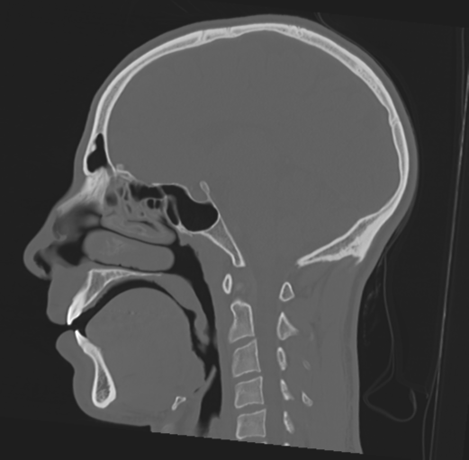 Anterior nasal spine fracture (Radiopaedia 46138-50494 Sagittal bone window 27).png