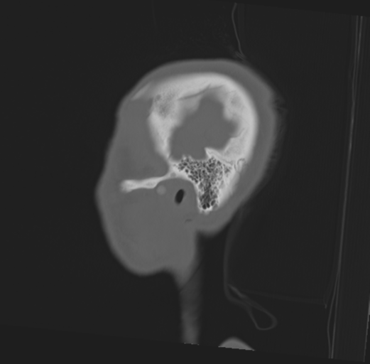 Anterior nasal spine fracture (Radiopaedia 46138-50494 Sagittal bone window 50).png