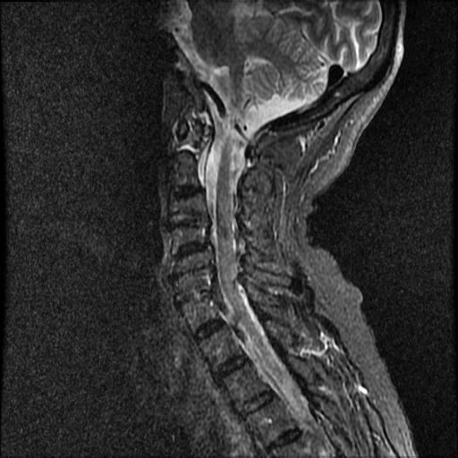 File:Anterior spinal artery syndrome (Radiopaedia 46335-50750 Sagittal STIR 7).png
