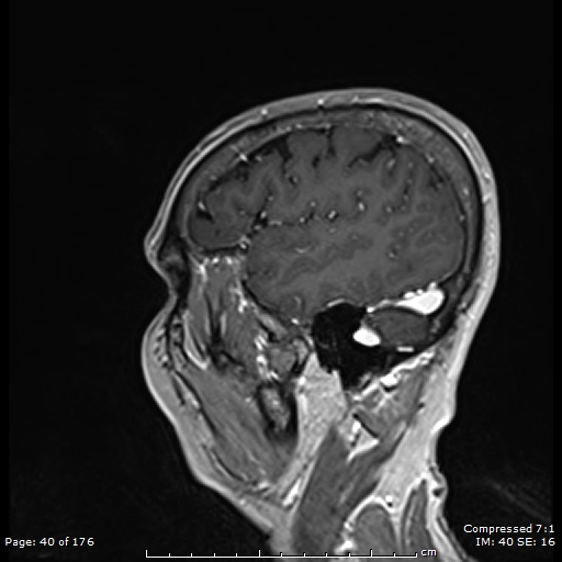 File:Anterior temporal lobe perivascular space (Radiopaedia 88283-104914 Sagittal T1 C+ 1).jpg