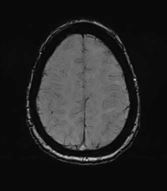 Anterior temporal pole cysts (Radiopaedia 46629-51102 Axial SWI 68).png