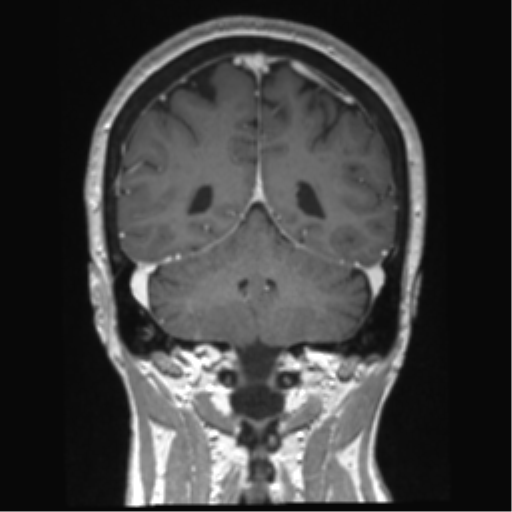 Anterior temporal pole cysts (Radiopaedia 46629-51102 Coronal T1 C+ 52).png
