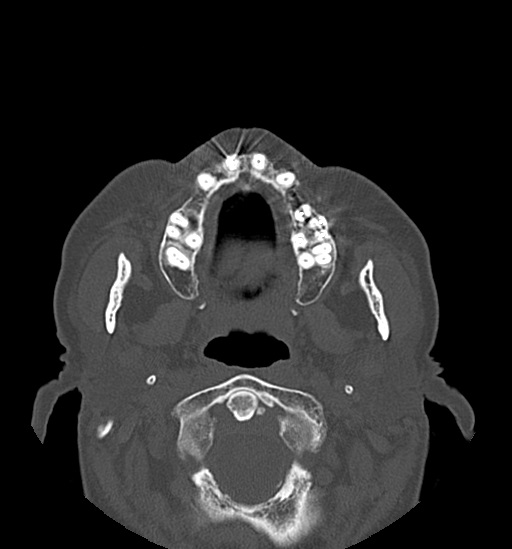 Anterior temporomandibular joint dislocation (Radiopaedia 59430-66784 Axial non-contrast 26).jpg