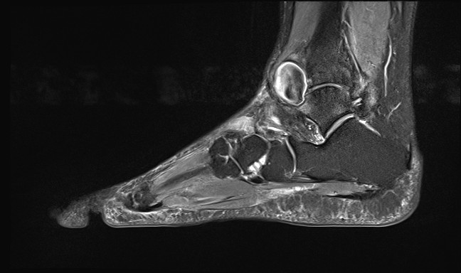 File:Anterior tibial artery false aneurysm (Radiopaedia 88984-105808 Sagittal STIR 12).jpg