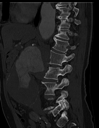 File:Anterior vertebral scalloping (abdominal aortic aneurysm) (Radiopaedia 66744-76067 Sagittal bone window 16).jpg
