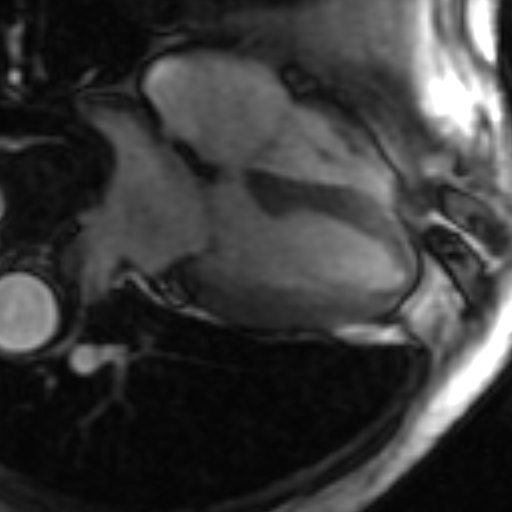 File:Anteroseptal hypokinesia after myocardial infarction (Radiopaedia 15978-15633 4 chamber view SSFE 4).jpg