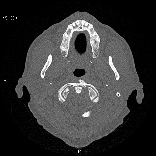 Antrochoanal Polyp (Radiopaedia 70510-80631 Axial bone window 4).jpg